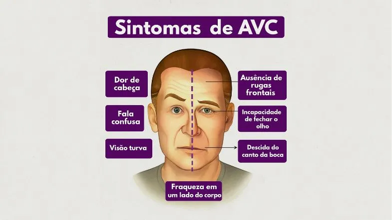 Dia Mundial do AVC: aumento entre jovens reforça a importância da formação em saúde 6 Ilustração mostra os principais sintomas do AVC na saúde, como fala confusa, fraqueza e desvio facial.